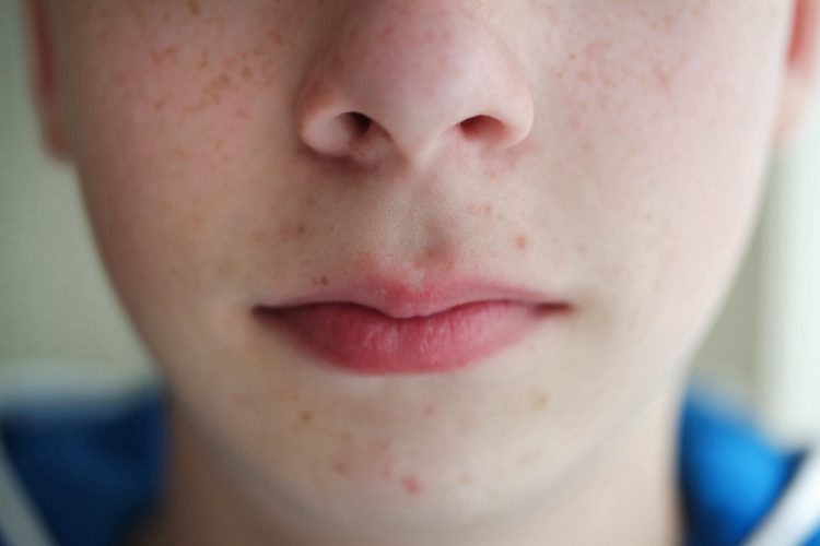 Close up of the young teenage skin, nose and lips.