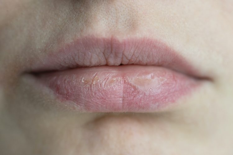 Closeup caucasian female face with brittle and dry chapped lips. Beauty dermatology concept.