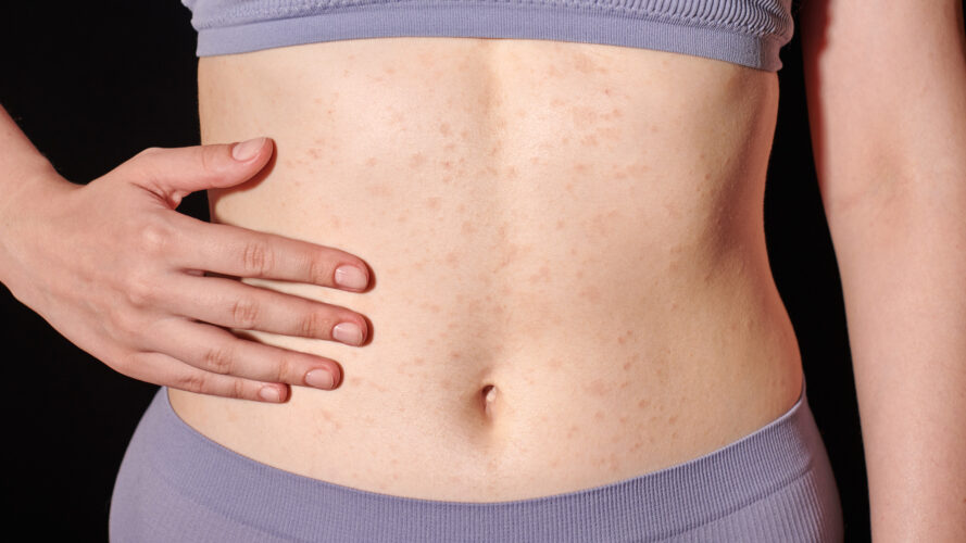 Red allergic rash on stomach skin, skin allergy, atopic dermatitis, eczema. Woman applying ointment